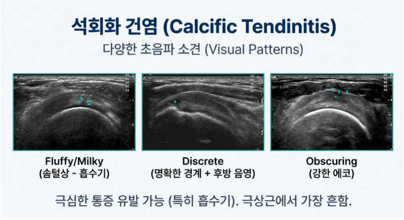 석회성 건염의 다양한 초음파 소견: 솜털상, 경계가 분명한 형태, 강한 에코