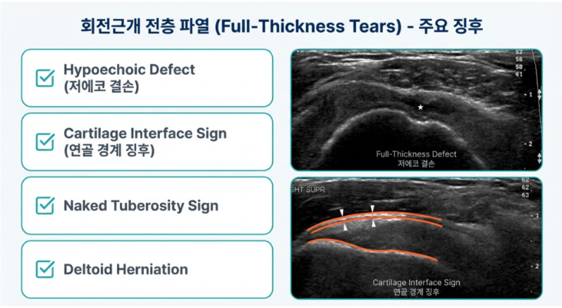회전근개 전층 파열의 주요 초음파 징후