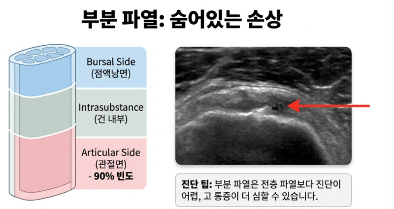 부분 파열의 위치 분류: 점액낭면, 힘줄 내부, 관절면