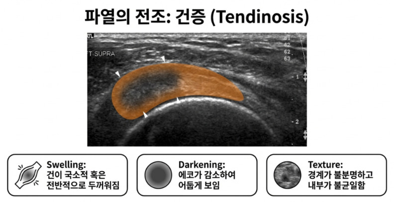 건증의 초음파 특징: 힘줄이 두꺼워지고, 어둡게 보이고, 내부가 불균일함